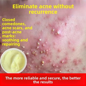 Crème Visage <span class=keywords><strong>Anti</strong></span>-Acné à l'Acide Salicylique à Effet Rapide, Très Vendue, avec Traitement Blanchissant et Cicatrisant, Soin de la Peau Marque Privée - Product Image 2