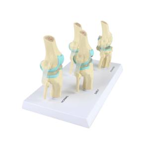 Modèle d'articulation du genou, anatomie humaine, modèle de genou pour l'enseignement de la pathologie, 4 étapes - Product Image 2