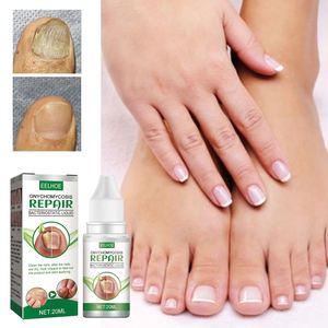 EELHOEWholesale 20ml Traitement et Réparation <span class=keywords><strong>des</strong></span> Mycoses <span class=keywords><strong>des</strong></span> <span class=keywords><strong>Ongles</strong></span> <span class=keywords><strong>des</strong></span> Pieds, Soin Anti-Fongique, Élimination <span class=keywords><strong>des</strong></span> Mycoses, Outils et Fournitures pour <span class=keywords><strong>Ongles</strong></span> Pedivac - Product Image 3