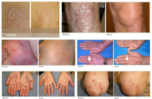 Çekirdek dermatoloji 308nm Excimer ışık UVB fototerapi Vitiligo sedef hastalığı tedavi lambası KN-5000C 55mW/cm² - Product Image 5