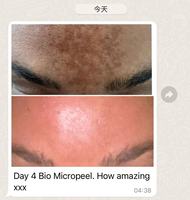 Kit de Récupération Cutanée ZS Spicules de Spongille Bio Microneedling Thérapeutique, Peeling aux Algues pour le Resurfaçage et l'Élimination des Taches, pour l'Hyperpigmentation