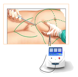 <span class=keywords><strong>Precio</strong></span> de fábrica 980 1470Nm Diodo Láser Mínimamente Invasivo Exceso de grasa 1470Nm endoLaser Lift 980Nm Estiramiento facial con láser Eliminación de grasa - Product Image 2