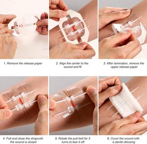 Perangkat penutup luka kulit dasi ritsleting medis sekali pakai untuk strip darurat perangkat penutup luka - Product Image 6