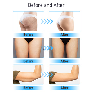 <span class=keywords><strong>Machine</strong></span> sous vide verticale 10in1 radiofréquence 80k lipo laser <span class=keywords><strong>lipocavitation</strong></span> lipo cavitation - Product Image 6