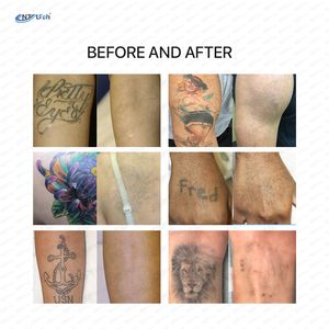 Cabezal de enfriamiento único, precio de promoción, picosegundo, Q conmutado, máquina de eliminación de tatuajes con láser rubí nd YAG - Product Image 4