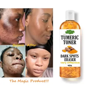 Fornecer a amostra livre de manchas escuras tumeric removedor de acne toner, oem, mm, escuras, clareamento mágico e remoção de manchas escuras