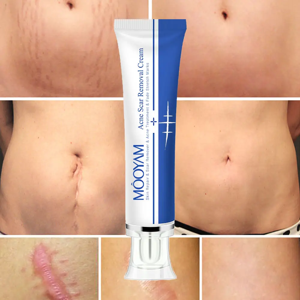 MOOYAM Strong Effective Acne Scar Removal Cream Pimples Stretch Marks Face Gel Tummy Tuck Tightening Stretch Mark Removal Cream