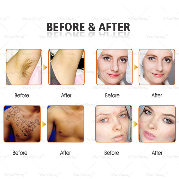 Niansheng 3 in 1 OPT Hair Removal + RF + ND YAG Laser Tattoo Removal Machine Laser Hair Removal Machine Price
