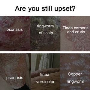 Kem trị bệnh vẩy nến trị ngứa-Phân phối Bán Buôn & tìm nguồn cung ứng từ nhà máy ban đầu (với tác dụng giảm ngứa & sửa chữa) - Product Image 3