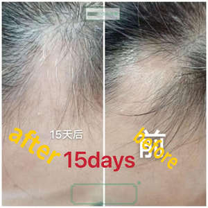 Nuevo Sérum Capilar Natural de Jengibre para el Crecimiento Rápido del Cabello, Spray para el Cuero Cabelludo, Tratamiento para la Caída del Cabello, Detiene la Pérdida de Cabello, con Biotina para Hombre y Mujer - Product Image 5