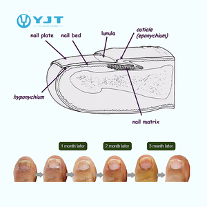 Dispositivo de Terapia Láser <span class=keywords><strong>para</strong></span> Hongos en las Uñas, Equipo Médico <span class=keywords><strong>para</strong></span> <span class=keywords><strong>Eliminar</strong></span> Onicomicosis, Gran Venta - Product Image 4