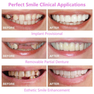 Impiallacciature denti sbiancamento protesi finte bretelle temporaneo finte copertura perfetta sorriso comodo Kit impiallacciature per protesi - Product Image 2
