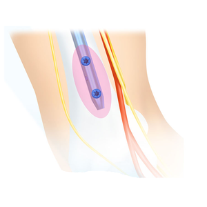 Chuyên Nghiệp Y Tế Chỉnh Hình Cấy Ghép Multiloc Humeral Lồng Vào Nhau Móng Tay 3.5 Khóa Vít - Product Image 3