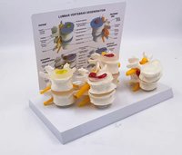 Modèle de comparaison de la dégénérescence des vertèbres lombaires en 4 étapes pour la formation médicale, modèle d'anatomie de la colonne vertébrale avec carte anatomique