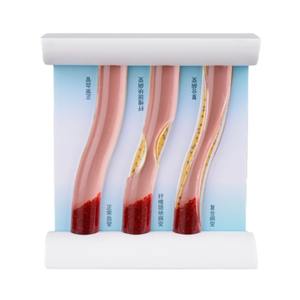 PVC人体动态高脂血症血管堵塞模型中血液稠度流的演示与比较 - Product Image 1