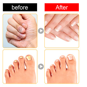 Crema reparadora de onicomicosis para el cuidado de las uñas, crema suave espesante para uñas, promueve el crecimiento saludable, tratamientos para uñas - Product Image 5