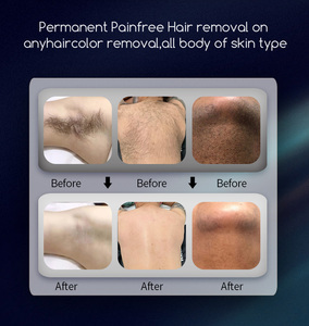 Novedades 2026, <span class=keywords><strong>Depiladora</strong></span> Láser de Diodo, Triple Longitud de Onda 755nm 808nm 1064nm, Máquina Láser de Depilación Permanente, <span class=keywords><strong>Precio</strong></span> - Product Image 6
