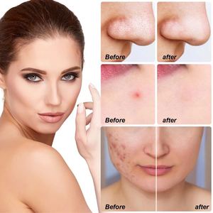 Elaimei Cerotti Idrocolloidali per il Trattamento di Brufoli e Acne 5 in 1 con Olio dell'Albero del Tè, Marchio Privato - Product Image 6