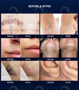 Compresor de Refrigeración Profesional para Empresas de Dispositivos Médicos Estéticos, Láseres de Alta Intensidad, Máquina de Depilación Láser para Clínicas - Product Image 2