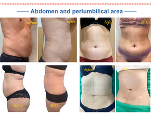 Máquinas profesionales de liposucción láser <span class=keywords><strong>no</strong></span> <span class=keywords><strong>invasiva</strong></span> 980nm 1470nm Lipólisis láser Endolaser Lifting facial - Product Image 6
