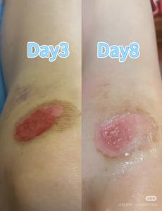 Hidrokolloid yara pansuman Bedsore teşvik yara şifa hidrokolloid tıbbi bant ölçeklenebilir çevre dostu hidrokolloid - Product Image 4