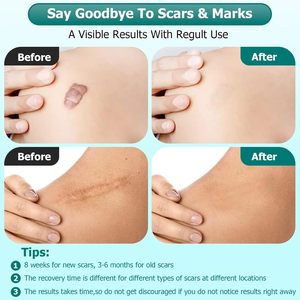 Aixin Private Scar Repair Advanced Scar Gel <span class=keywords><strong>ayuda</strong></span> <span class=keywords><strong>a</strong></span> mejorar la reparación de cicatrices antiguas y nuevas humedecer sin secar Gel reparador - Product Image 4