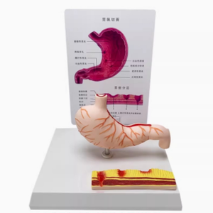 Modelo de Estómago con Estructura Patológica: Gastritis Atrofiada, Úlcera Perforada, Modelo de Sistema Digestivo Humano - Product Image 3