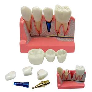 Modelo de Enseñanza de Implantes Dentales, Modelo de Demostración de Anatomía de Extracción de Dientes con Piezas de Repuesto para Entrenamiento en Terapia Oral - Product Image 1