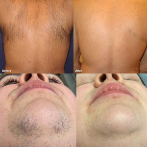 4 Wavelengths 755 808 940 1064nm Professional Diode <strong>Laser</strong> <strong>Hair</strong> <strong>Removal</strong> Machine 1600W with AI <strong>Hair</strong> Follicle Camera - Product Image 4