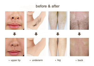 Zs Bán Buôn Giá 755 + 808 + 1064 Tri Bước Sóng Ice Bạch Kim Tóc Loại Bỏ Máy Trên Nách Trở Lại Chân Cánh Tay Mặt Bikini Dòng - Product Image 6