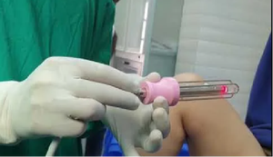 Лидер продаж, утягивающая палочка для влагалища, 980 нм, 1470 нм - Product Image 2