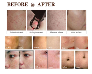 เครื่องเลเซอร์ทางการแพทย์ทางการแพทย์แบบพกพา Co2เครื่องเลเซอร์เศษส่วนสำหรับการกำจัดช่องคลอดยืดเลเซอร์ - Product Image 6