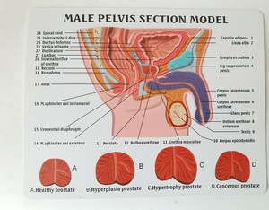Modelo Anatómico de Pelvis Masculina Humana con Enfermedad Sagital en 4 Etapas, Anatomía de la Cavidad Pélvica, Ciencia Médica - Product Image 2