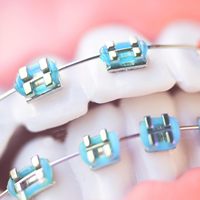 ZZSU SDBRACE 101 Vente chaude Grillz dentaire métallique amovible style punk pour les dents, accessoire de mode Hip Hop pour fêtes et costumes