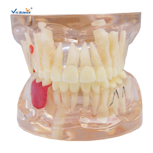 Modelo de Dientes Humanos para Ciencias Médicas, Modelo Patológico de Pérdida Prematura de Dientes Deciduos, Transparente, Mixto con Dientes Faltantes - Product Image 1