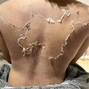 Alidina 99% 70% Espículas Espongila Manchas Escuras Reduzir Estrias Reduzir Kit Tratamento Efeito Óbvio para Massagem Salão Uso - Product Image 5