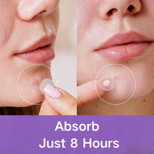 40 Cerotti Idrocolloidali per Acne, Cosmetici Originali per Coprire Acne e Imperfezioni su Viso e Pelle - Product Image 2