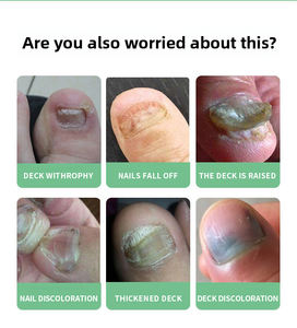 BSHIPRO Líquido Antifúngico Herbal Tolunaftato 4ML para el Cuidado <span class=keywords><strong>de</strong></span> la Piel y <span class=keywords><strong>Uñas</strong></span> <span class=keywords><strong>de</strong></span> <span class=keywords><strong>los</strong></span> Pies, Pie <span class=keywords><strong>de</strong></span> Atleta (Tinea Pedis) - Product Image 2