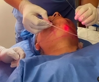 La plus nouvelle machine de liposuccion de levage de visage de laser de diode d'Endolaser 1470nm 980nm