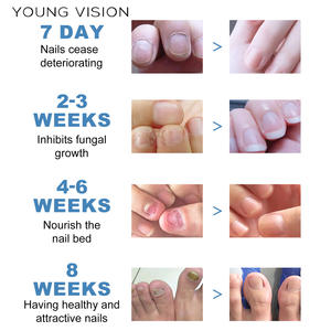 Parches de reparación Tratamiento de uñas de los pies Pegatinas de corrección antihongos Parches de reparación de uñas para uñas dañadas - Product Image 6