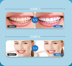 Jeringa de Gel para blanqueamiento dental, peróxido de carbamida 0.1%-44%, logotipo personalizado, el más barato, venta al por mayor - Product Image 3