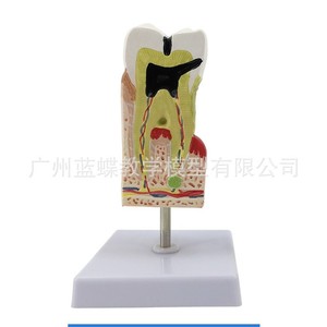 Modelo de caries dental; modelo patológico completo de enfermedades dentales; modelo anatómico seccional del diente; dientes; - Product Image 2