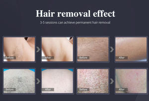 Kedatangan Baru 2026 Mesin <span class=keywords><strong>Laser</strong></span> Epilator <span class=keywords><strong>Diode</strong></span> Tiga Panjang Gelombang 755nm 808nm 1064nm Penghilang Rambut Permanen Harga Mesin <span class=keywords><strong>Laser</strong></span> - Product Image 5