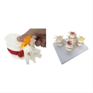 Modelo de demostración de enseñanza médica ADA de hernia de disco lumbar y modelo de comparación de columna lumbar mórbida de etapa - Product Image 1