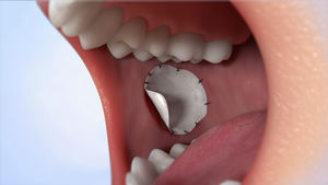 Biosis Membran GTR Gigi, Implan Gigi Tempelan Tulang Lembar Kolagen Steril Ukuran 30X40Mm - Product Image 6