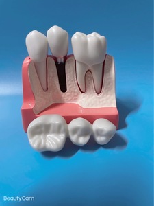 Modèle de dents dentaires modèle de Solution d'<span class=keywords><strong>implant</strong></span> 4 fois restauration de prothèse <span class=keywords><strong>dentaire</strong></span> explication d'<span class=keywords><strong>implant</strong></span> <span class=keywords><strong>dentaire</strong></span> <span class=keywords><strong>couronne</strong></span> de pont détachable - Product Image 4