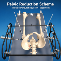 Cadre de réduction pelvienne en fibre de carbone radiolucent pour chirurgie de fracture pelvienne minimalement invasive, compatible avec le C-arm