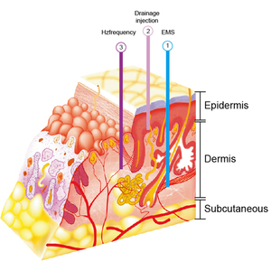 Tốt Nhất Chống Lão Hóa Kem Dưỡng Ẩm Làm Trắng Mesotherapy Thiết Bị Chăm Sóc Da Ống Tiêm Sản Phẩm Trên Khuôn Mặt Thiết Bị Thiết Bị - Product Image 6