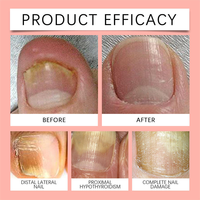 SAMVO Patchs hydrogel anti-fongiques pour ongles, correction rapide et sans effort pour usage domestique, résultats rapides, durée de conservation de 3 ans