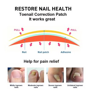 Outil professionnel de correction des ongles incarnés pour le soin des pieds, réduit la douleur et la pression - Product Image 4